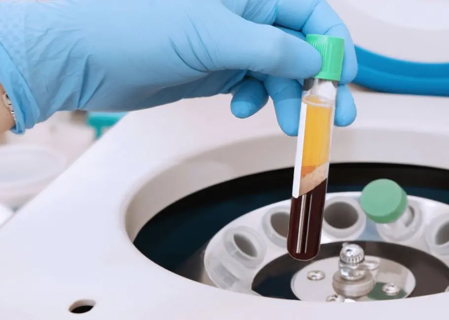 PRF (Platelet-Rich Fibrin)